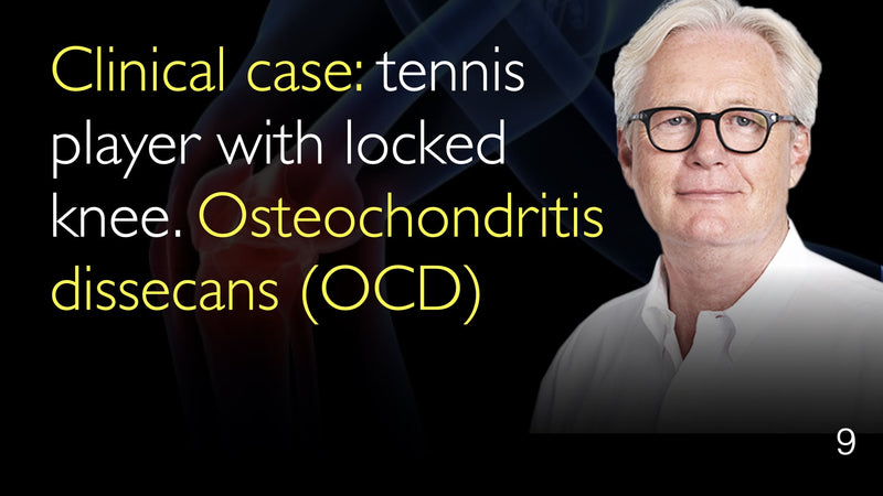 Клинический случай. Теннисист с заблокированным коленом. Рассекающий остеохондрит (ОКР). 9